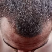 თავის კანის სებორეა: სიმპტომები, მიზეზები, დიაგნოსტიკა, მკურნალობა