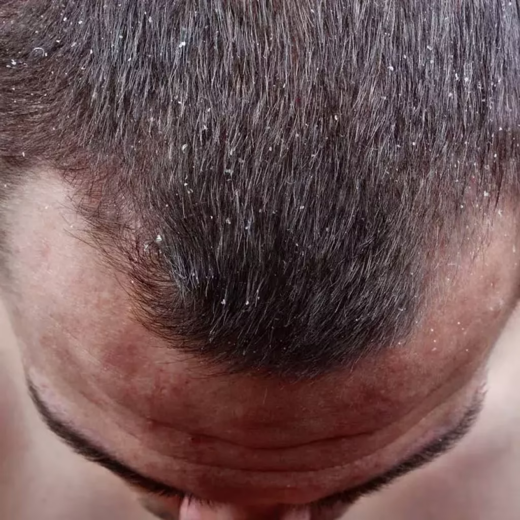 თავის კანის სებორეა: სიმპტომები, მიზეზები, დიაგნოსტიკა, მკურნალობა