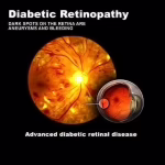 დიაბეტური რეტინოპათია